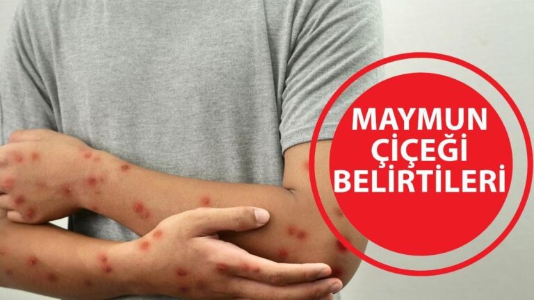 MAYMUN ÇİÇEĞİ BELİRTİLERİ: Maymun çiçeği virüsü öldürüyor mu, nasıl bulaşır? Maymun çiçeği Türkiye’de görüldü mü?